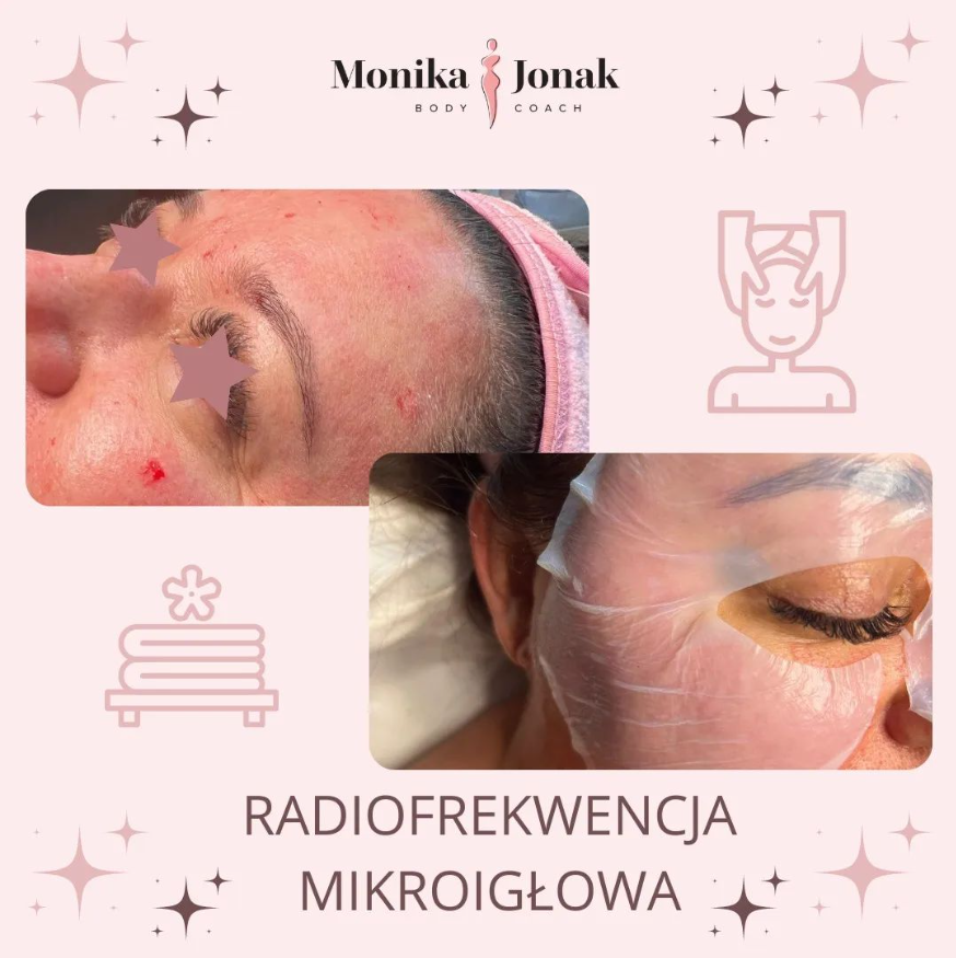 Radiofrekwencja mikroigłowa