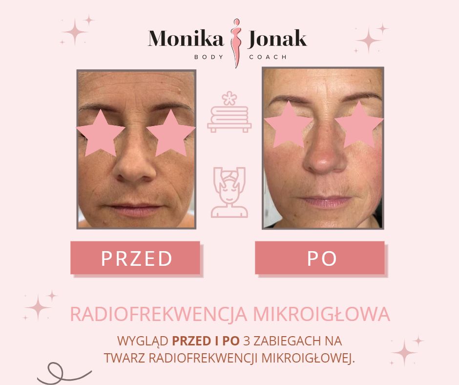 Radiofrekwencja mikroigłowa